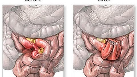 Enteroenterostomy CPT code - simplify medical coding
