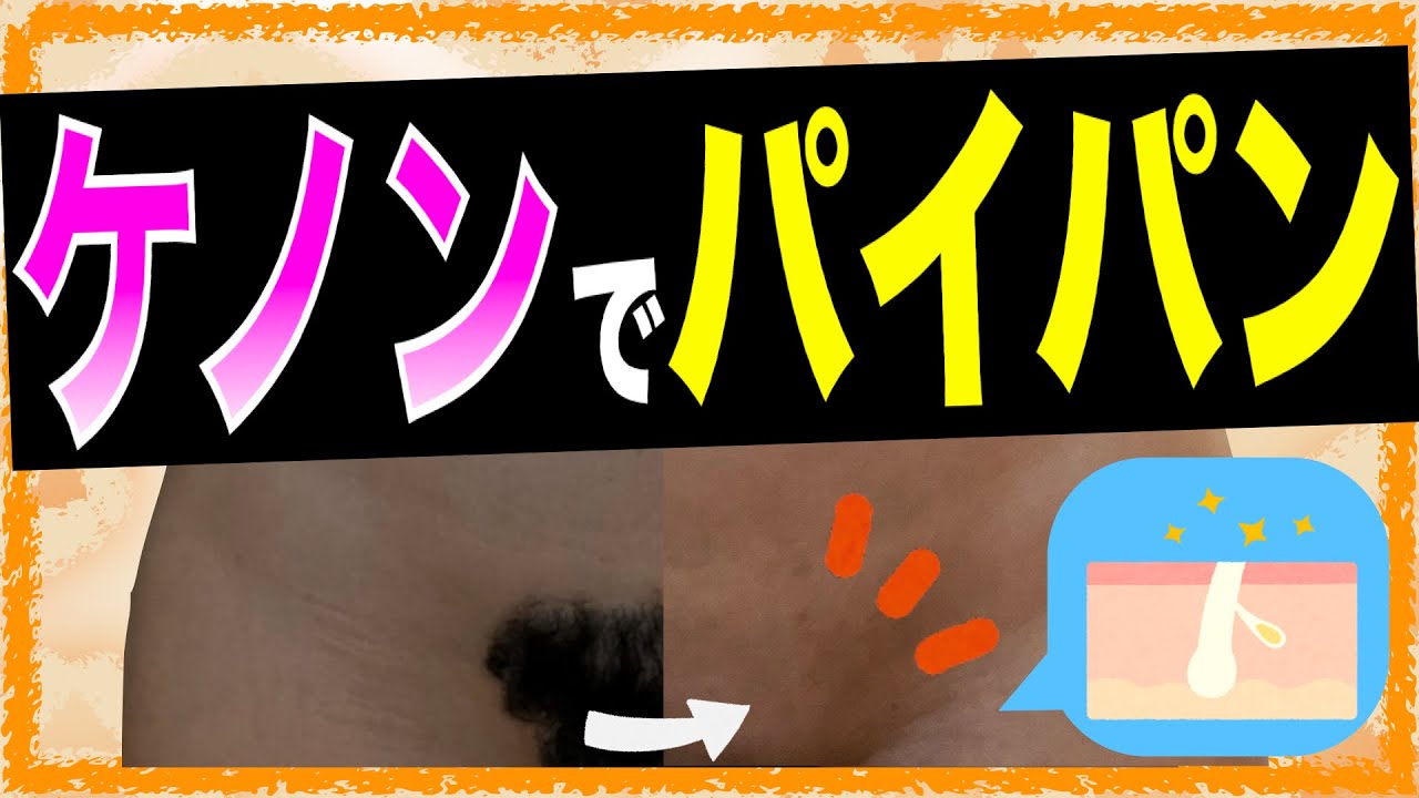 パイパンアップ 徹底解説】ケノンでVIO脱毛！家で簡単にパイパンにする“３つのポイント” - YouTube