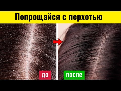 Касторовое масло для волос от перхоти применение в домашних условиях