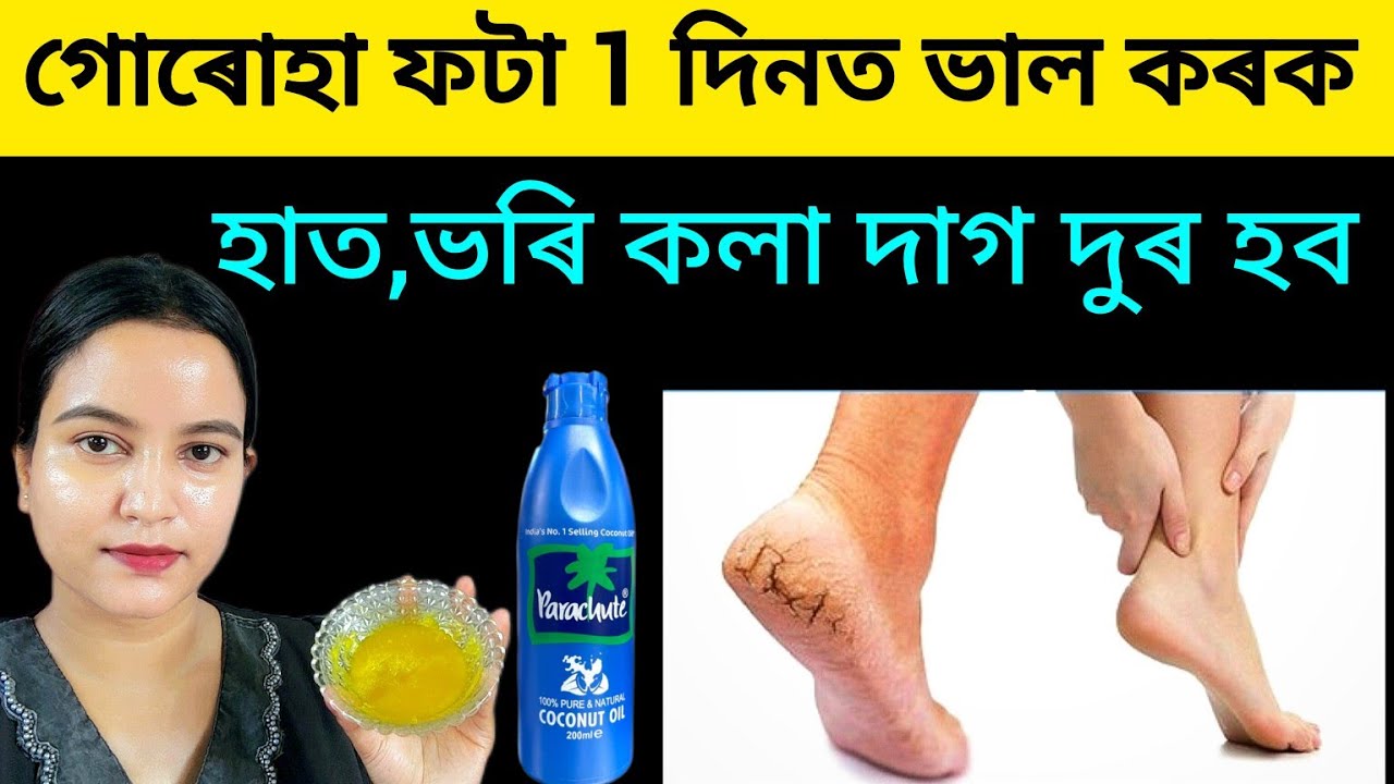 এদিনত গোৰোহা ফটা,হাত, ভৰি ফটা, শুকান ছাল দুৰ হব ছাল বগা উজ্বল হব জিলিকি উঠিব ।।