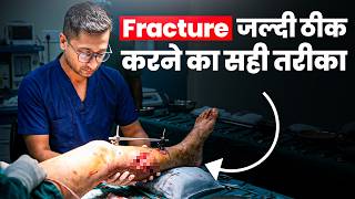 Fracture जल्दी कैसे ठीक करें? | AIIMS Doctor Reveals Bone Healing Secrets