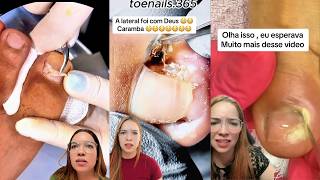 Satisfying Ingrown Toenail Removal 😱 | Instant Relief!