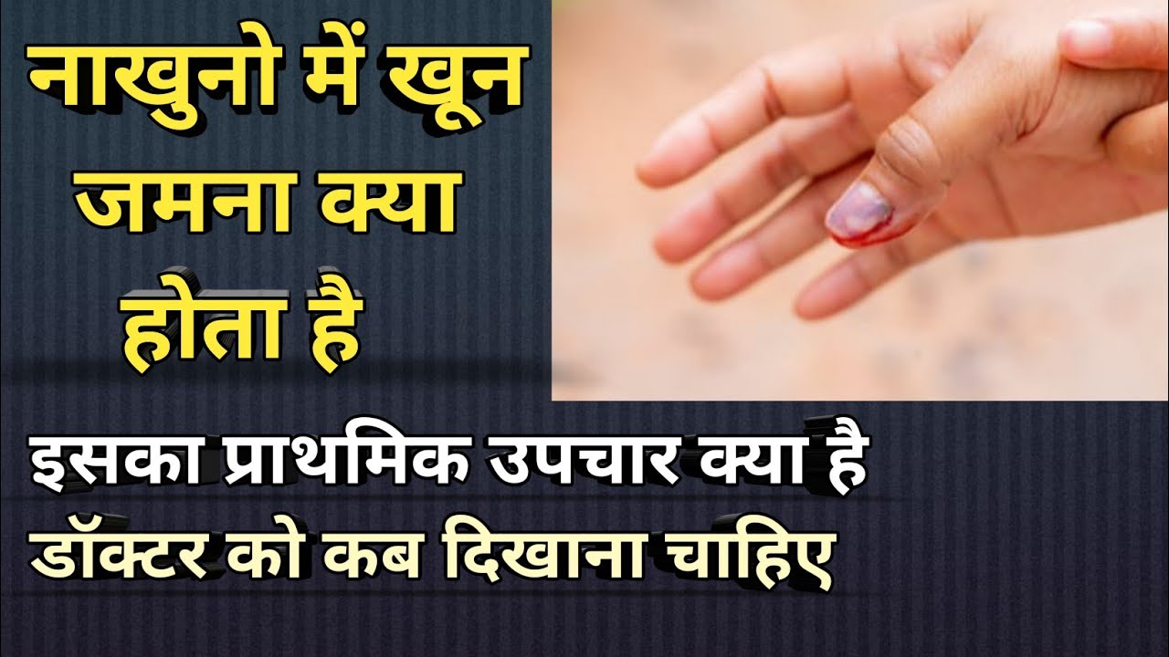 Nakhuno me khun jamna kya hota hai? What is subungual haematoma