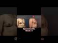 😱Grade 3 Gynecomastia Surgery Pune #plasticsurgery #gynecomastiasurgeryindia #cosmeticsurgery