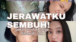 Produk MURAH sembuhkan jerawat batu, bekas jerawat - Durasi: 15.30. 