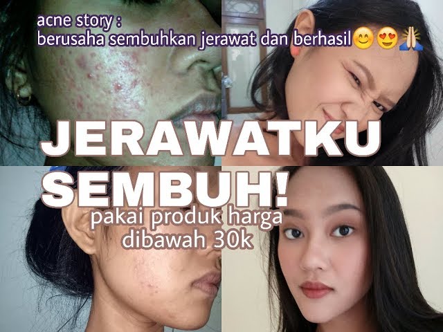 Produk MURAH sembuhkan jerawat batu, bekas jerawat class=