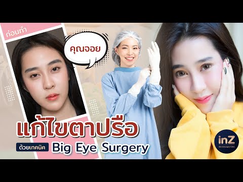 แก้ไขตาปรือ ตาง่วงนอน ด้วยเทคนิค "Big eye surgery"