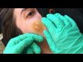 Removing Boyfriend's Cyst!