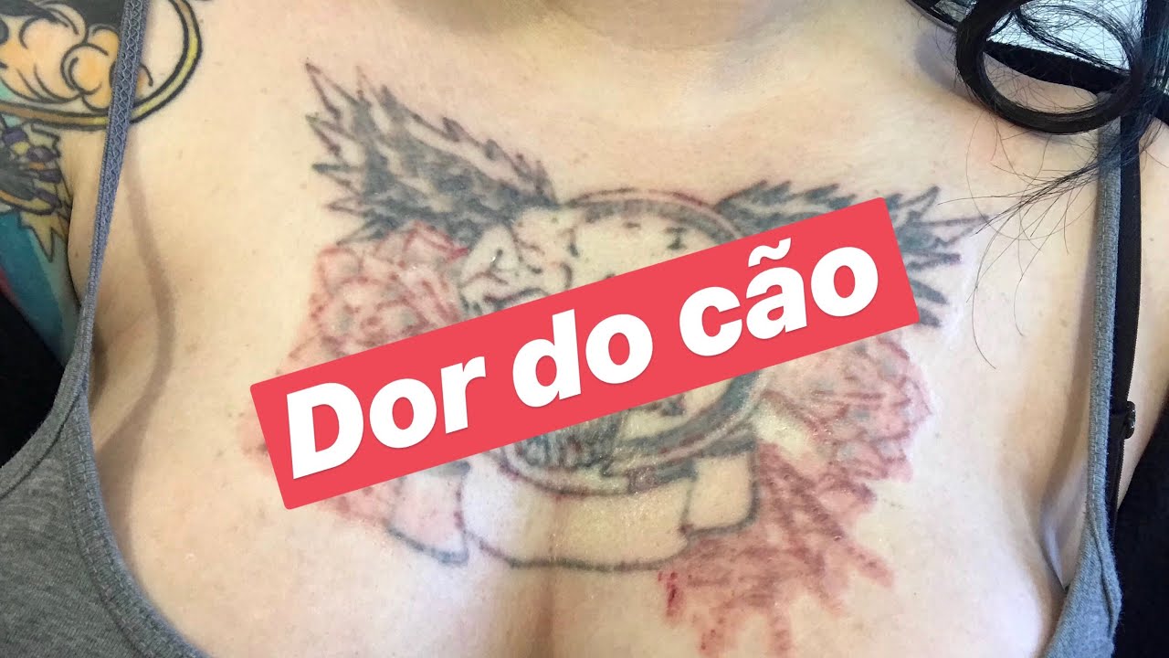 ULTIMA SESSÃO A LASER?