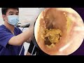 ASMR耳掃除:ドライタイプ耳垢の掘削ライブ中継📡