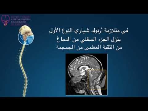 متلازمة أرنولد كياري النوع الأول، تكهف النخاع  و إنحناء العمود الفقري