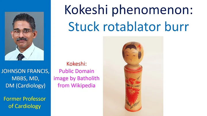 Kokeshi phenomenon: Stuck rotablator burr
