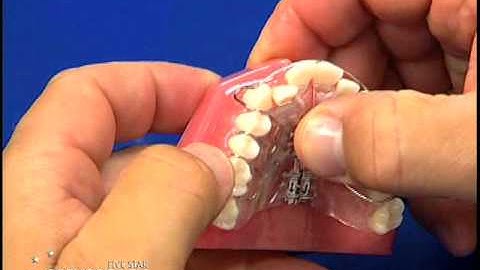 Adams clasp adjustment by Five Star Orthodontic Lab and Supply