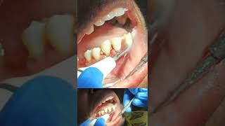 Years of damage but recovery in a minute #dentist #satisfying #retainer #trend #satisfying #viral