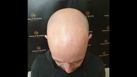 Scalp Micropigmentation Results From Scalp Micro Scotland