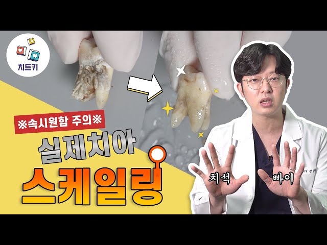 ※속 시원함 주의※ 스케일링, 이렇게 진행됩니다! 실제 치아 치석제거 과정 대공개! 스케일링 후 주의사항까지😎