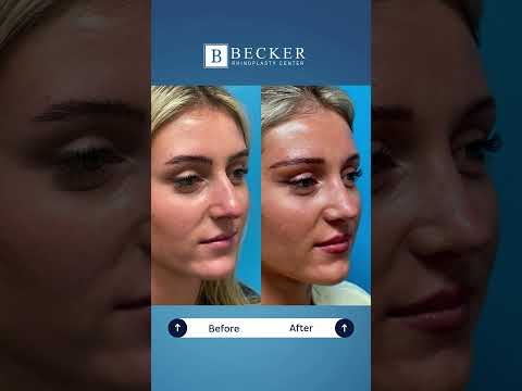 Video thumbnail: 18 Months After Rhinoplasty 👃💖 · Becker Rhinoplasty Center