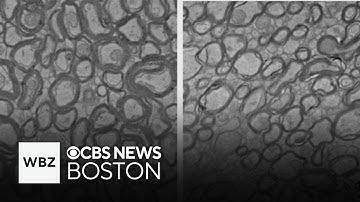 Harvard Medical School Alzheimer