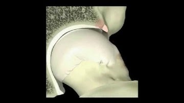 CAM Impingement Animation | CAM Pathology | Hip Pain | Nashville Hip Institute