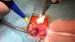 Hemorrhoidectomy for Thrombosed External Hemorrhoids   Sezai Leventoglu, MD; B Bulent Mentes, MD