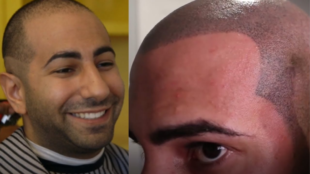 THE WORST SMP (SCALP MICROPIGMENTATION) RESULT EVER FOR TREATING HAIR LOSS!  *FT. FOUSEYTUBE!* - YouTube