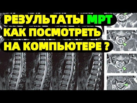 МРТ позвоночника Чем и как открыть файл DICOM на компьютере ?