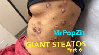 Large Steatocystomas part 6. The story continues. Butter bump drainage and extractions. MrPopZit