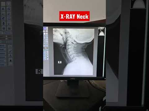 Digital X-ray Neck #cervicalspine #shorts #xray #radiology