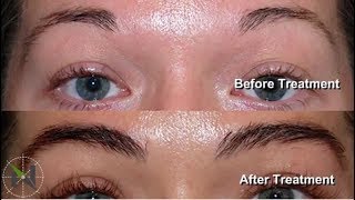 Eyebrow Hair Restoration - Dr. Robert Niedbalski - Tacoma, WA