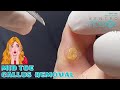 Mid toe callus removal|Αφαίρεση μεσοδακτύλιου κάλου|Κέντρο Ποδιού|Kentro Podiou Podiatry|Podiatrist