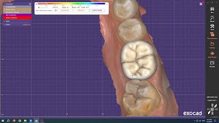 Exocad Onlay Design For Lithium Disilicate on Tooth 46 (First Molar)