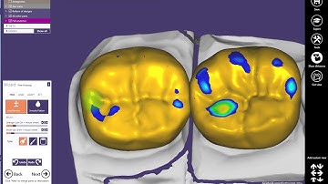 EXOCAD Design demo part 2 10-24-2017