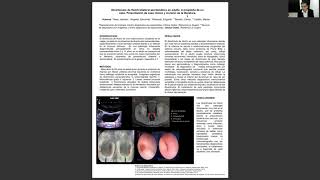 Diverticulo De Hutch