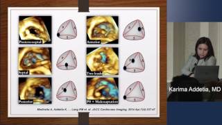 2-D Vs. 3-D TTE for Tricuspid Valve Anatomy