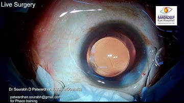Carousel technique for soft cataract Live surgery from Nandadeep Eye Hospital Dr Sourabh Patwardhan