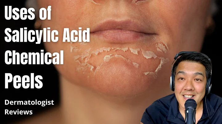 Salicylic Acid Peels | Indications