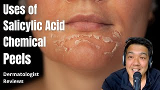 Salicylic Acid Peels | Indications