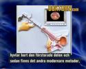 Video: Prostata Adenom Hos Män - Symtom, Behandling, Konsekvenser Av Operation