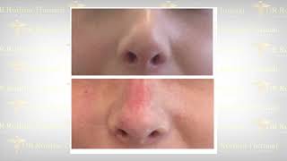 Modelim i hundës pa kirurgji/ Nose job