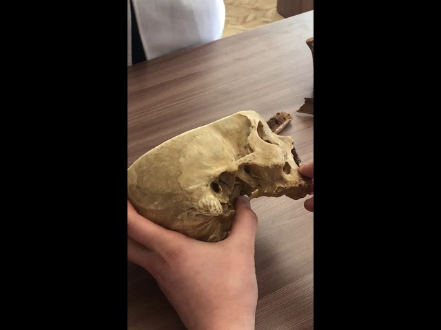 Флегмоны и абсцессы головы (лицевой отдел) часть 1