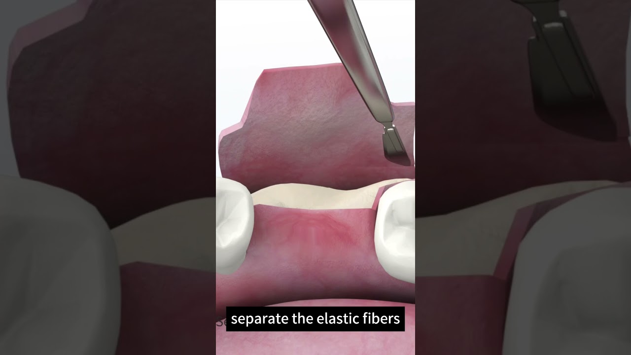 Dental Tension Release Comb Function Demonstration 