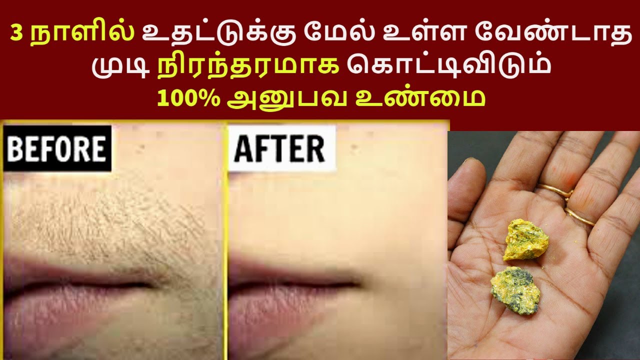     Permanent unwanted upperlip underarm hair removal homeremedy