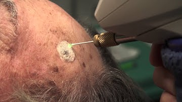 Watch & Learn: Cryosurgery