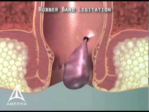 hemorrhoid treatment, hemorrhoid surgery, haemorrhoid surgery - Band Ligation