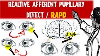 Understanding Relative Afferent Pupillary Defect (RAPD) & Marcus Gunn pupil