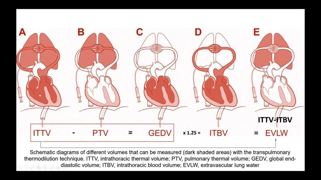 Transpulmonary Thermodilution method Case studies YouTube