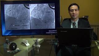 Mapeamento e Ablação de diferentes tipos de Taquicardia Ventricular:  Ablação Epicárdica