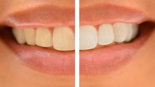 How to Whiten Teeth in Photoshop! TWO STEPS!!