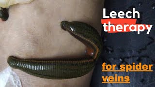 leech therapy | blood purification #shorts