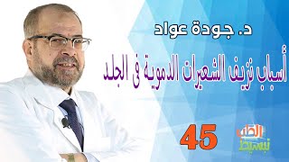 تبسيط الطب( 45  )| أسباب نزيف الشعيرات الدموية فى الجلد | د. جودة عواد